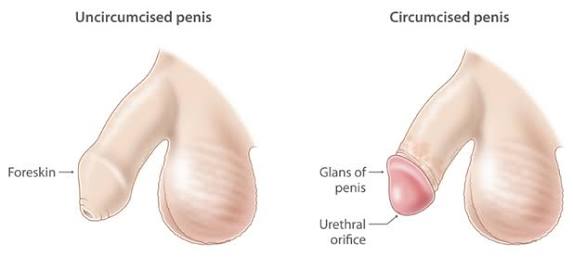 Circumcision, Phimosis Treatment