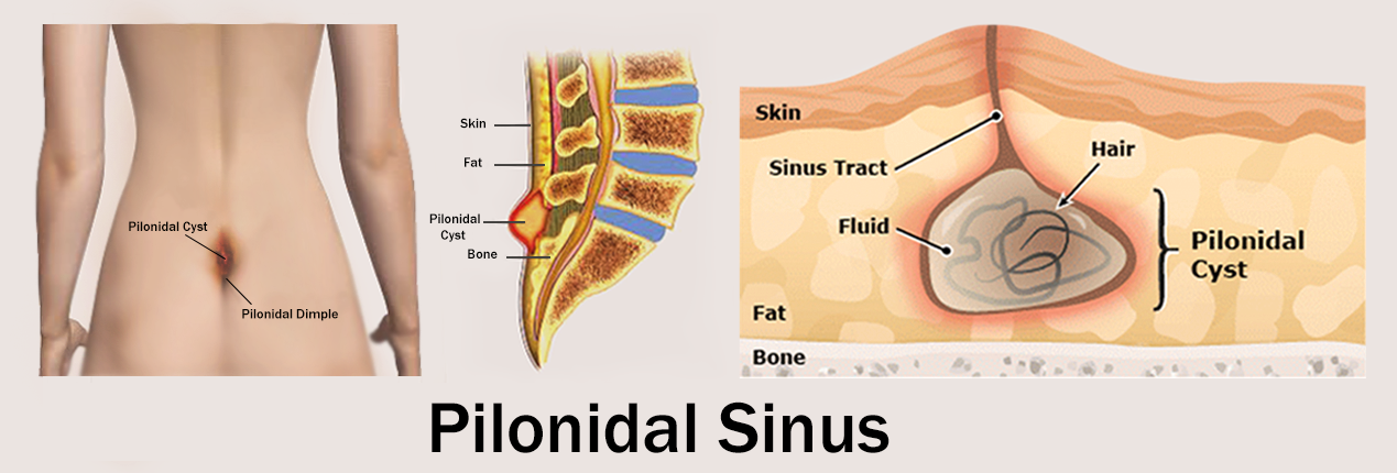 Pilonidal sinus treatment  Laser surgery for pionidal sinus