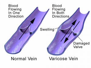 Which Types of Doctors Treat Varicose Veins? - Hinsdale Vein & Laser
