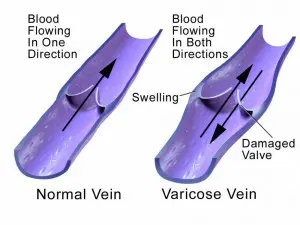 Best Varicose Veins Treatment in Ludhiana